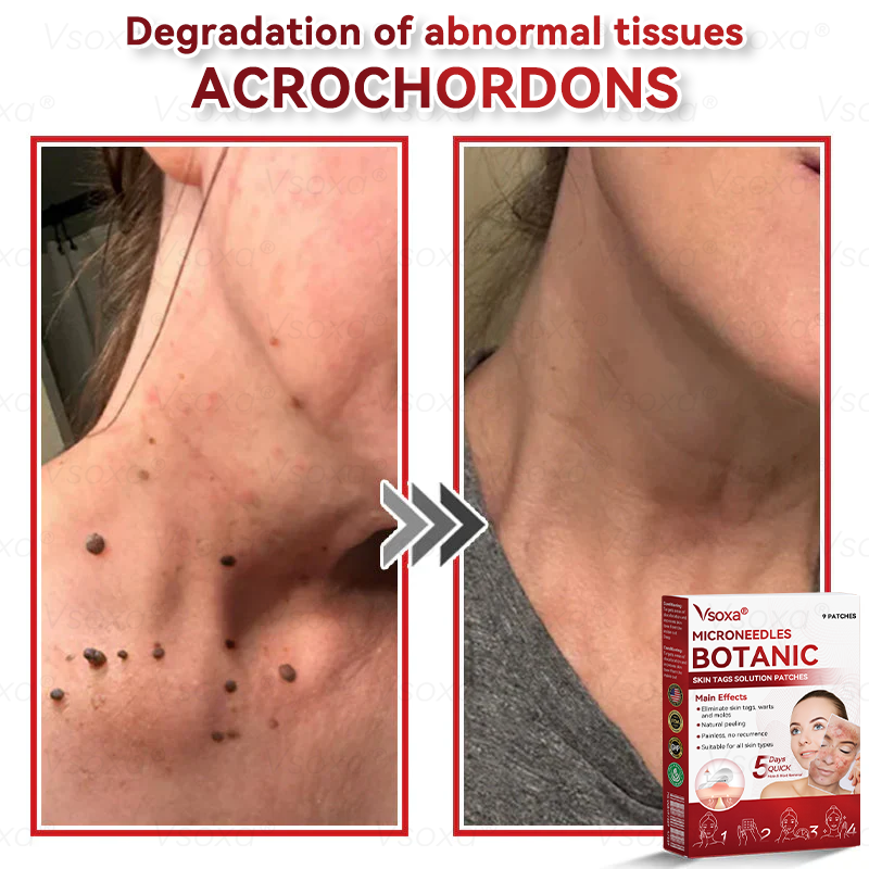 𝑉𝑠𝑜𝑥𝑎®💧Microneedles Botanical Skin Tags Solution Patches - Made in the USA👩‍⚕️