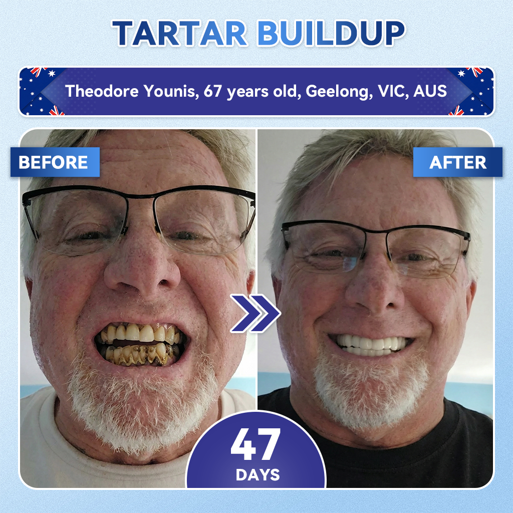𝑮𝒍𝒊𝒎𝒎𝒆𝒓𝒍𝒚® 🦷 Tideglusib Fast‑Dissolving Tooth & Gum Repair Oral Strips🎋(Supports tooth repair and helps relieve gum discomfort and other common oral concerns)