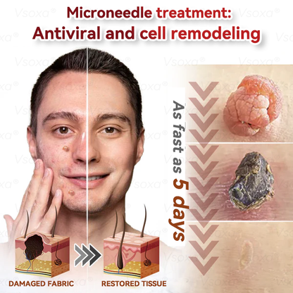 𝑉𝑠𝑜𝑥𝑎®💧Microneedles Botanical Skin Tags Solution Patches - Made in the USA👩‍⚕️