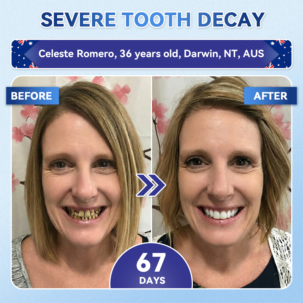 𝑮𝒍𝒊𝒎𝒎𝒆𝒓𝒍𝒚® 🦷 Tideglusib Fast‑Dissolving Tooth & Gum Repair Oral Strips🎋(Supports tooth repair and helps relieve gum discomfort and other common oral concerns)